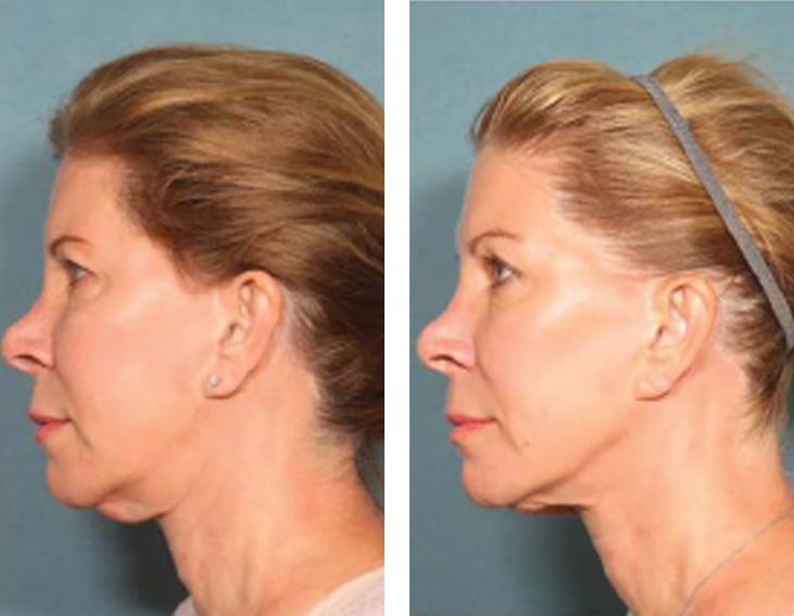 Sofwave efekty 1 Sofwave efekty 1