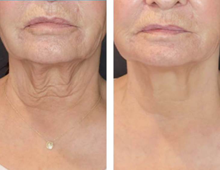 Sofwave efekty 2 Sofwave efekty 2